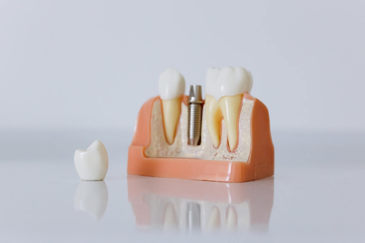 Czy implanty zębowe mogą się nie przyjąć?