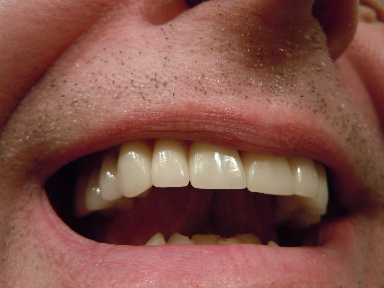 Wybielanie zębów laserem efekty